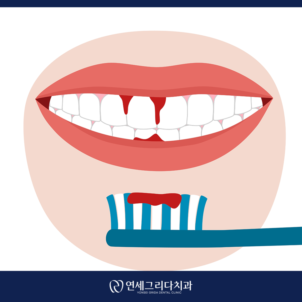 염창역잇몸치료, 양치할 때 자꾸 피가 난다면? 관련 이미지 2