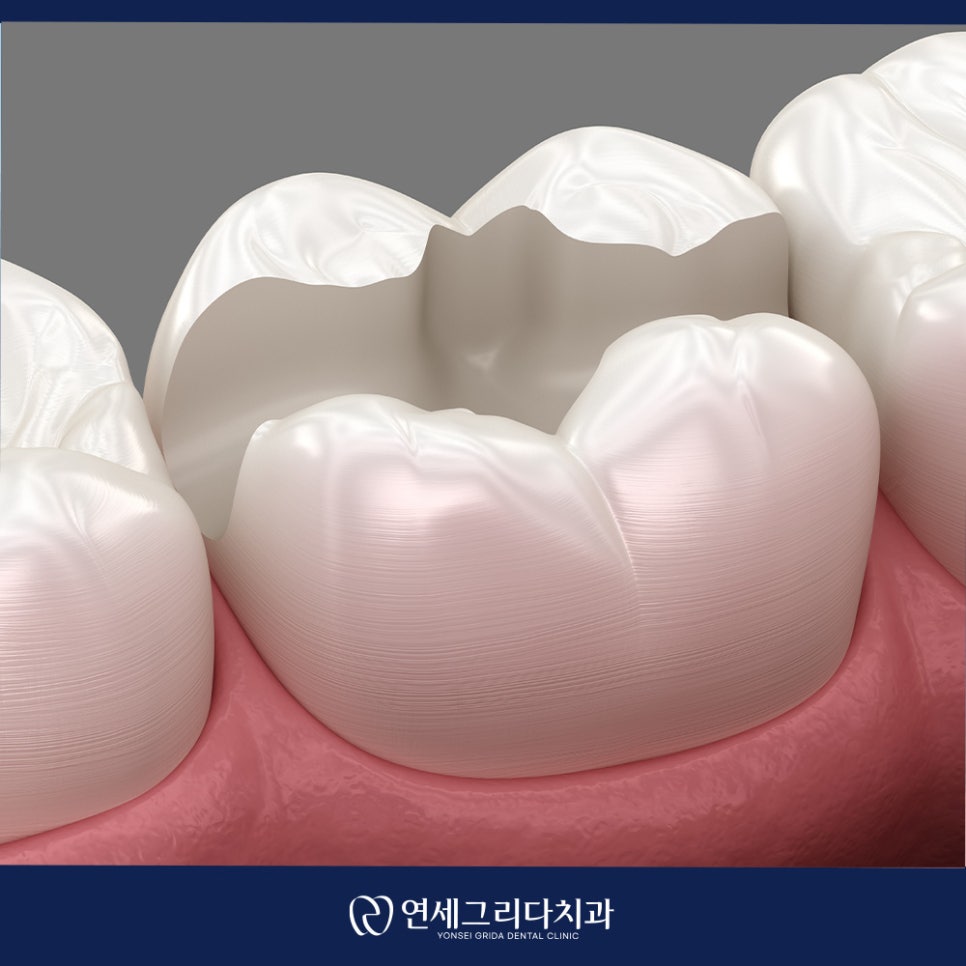 인레이 탈락 재부착이 가능할까요? 관련 이미지 4