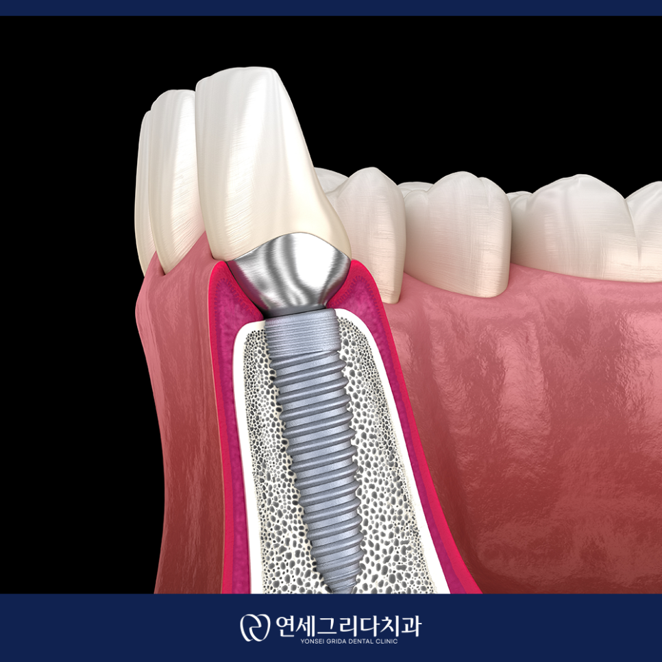 염창역치과, 임플란트 고민이라면 꼭 확인하세요! 관련 이미지 4