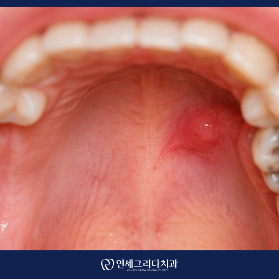 Why You Should Not Ignore Pain in the Roof of Your Mouth image 3