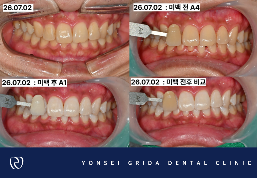 Yeomchang Station Dental Clinic: If You Want to Brighten Your Tooth Color in a Short Time with One-Day Whitening image 4
