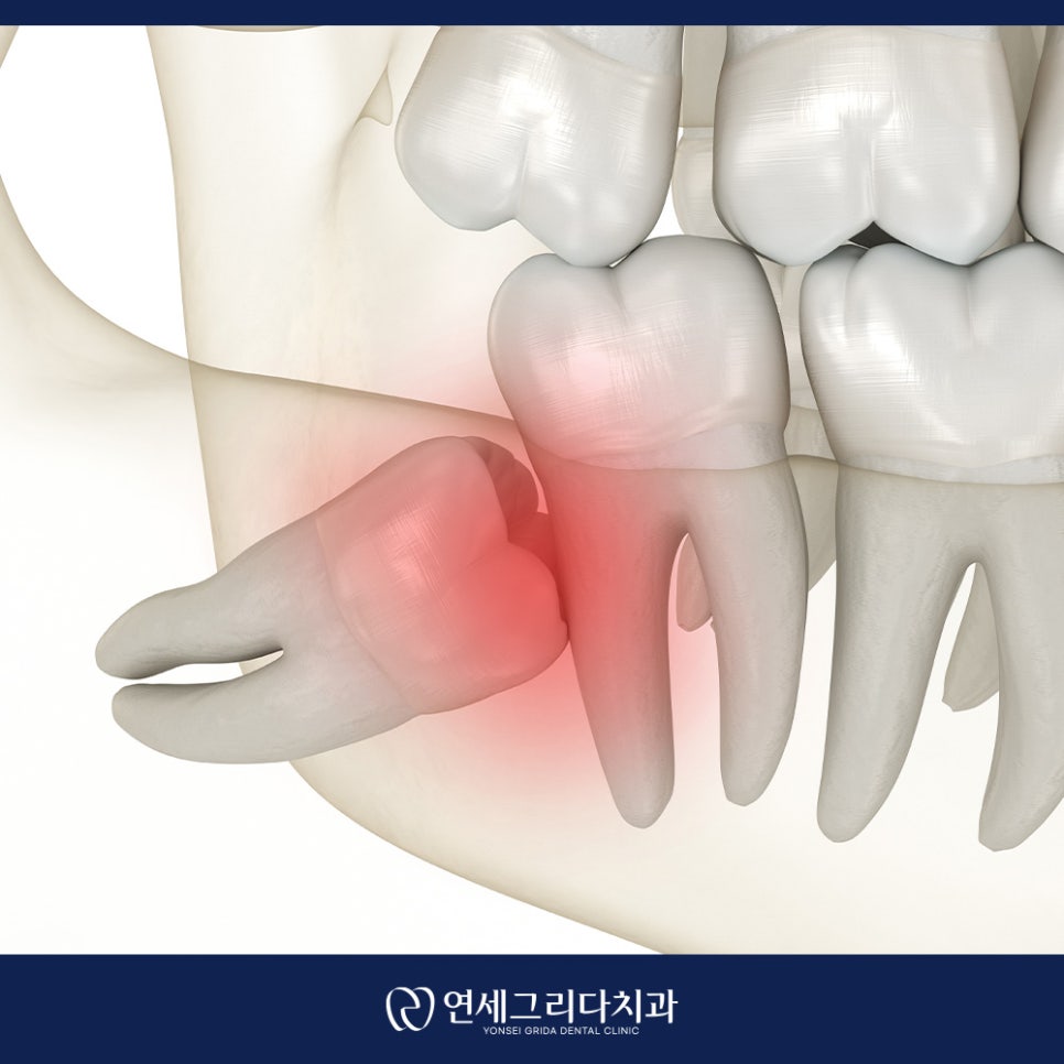 사랑니 잇몸 부음 그냥 두면 안 되는 이유는? 관련 이미지 6