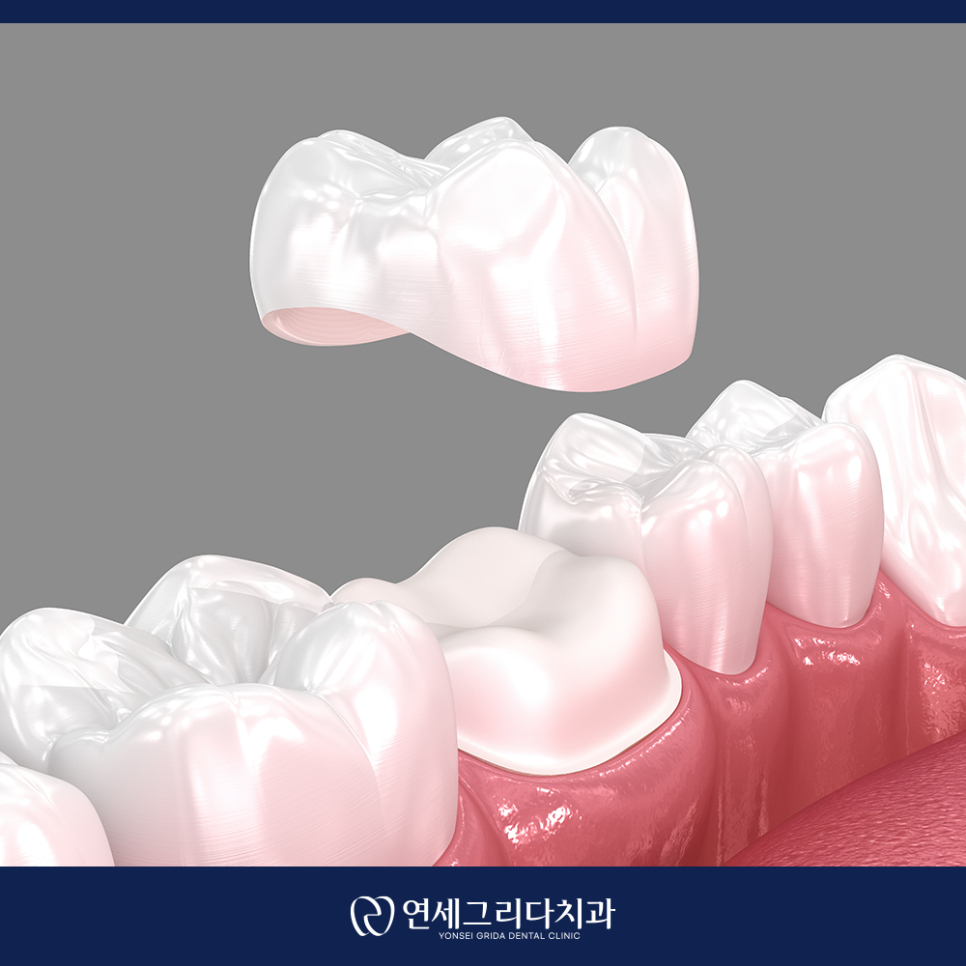 크라운 교체 시기, 이런 증상이 있다면 교체 신호 관련 이미지 4