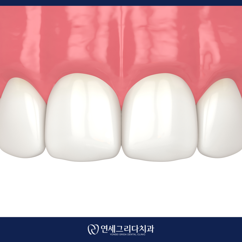 앞니 레진치료, 웃을 때 보이는 틈이 고민이라면 관련 이미지 3
