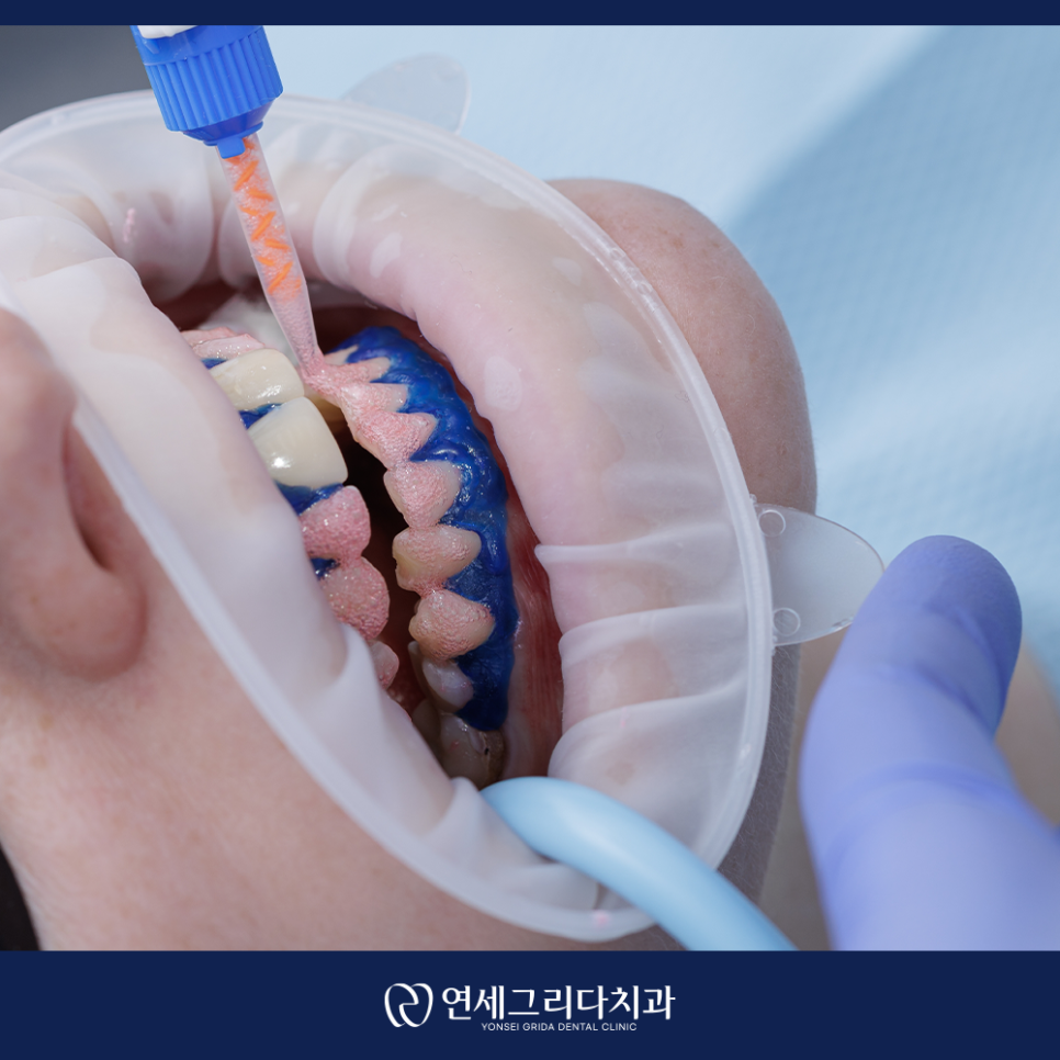 Yeomchang Station Dental Clinic: If You Want to Brighten Your Tooth Color in a Short Time with One-Day Whitening image 3
