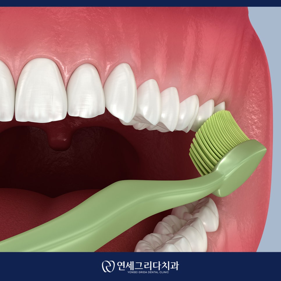 치경부마모증 시린 증상이 생겼다면? 관련 이미지 6