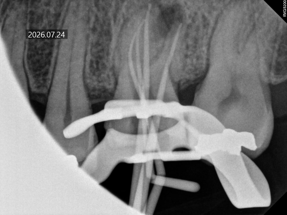 What Happens If You Leave Untreated Cavities Without Symptoms image 3