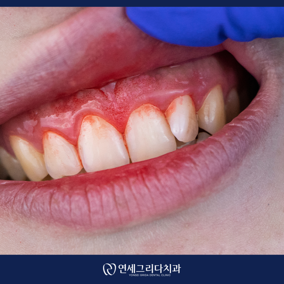 What Causes Blood to Pool in the Gums? image 3