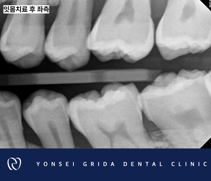 Deungchon Station Dental Clinic: My Front Tooth Broke and My Gums Hurt image 11