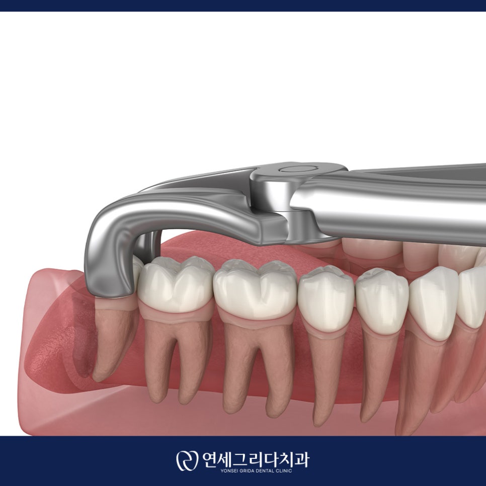사랑니 잇몸 부음 그냥 두면 안 되는 이유는? 관련 이미지 4