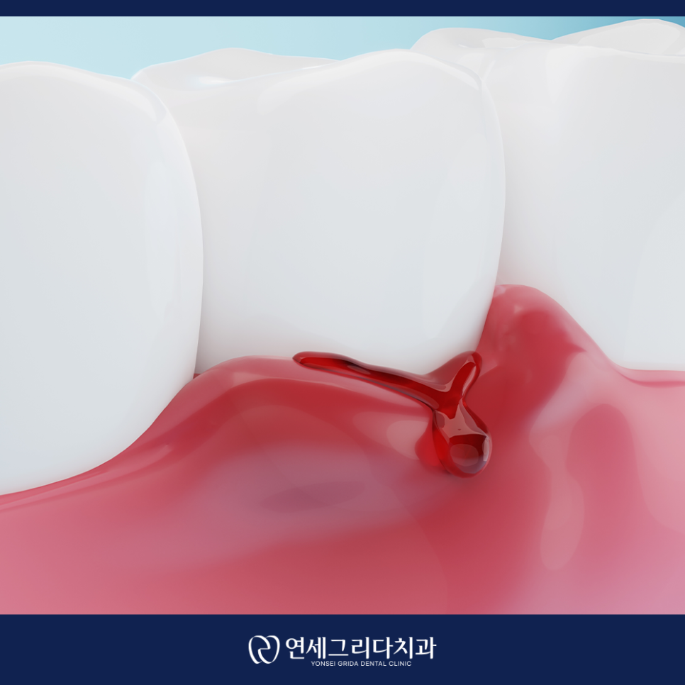 What Causes Blood to Pool in the Gums? image 5