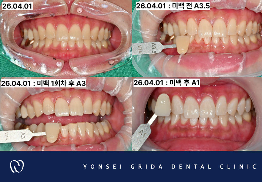 Yeomchang Station Dental Clinic: If You Want to Brighten Your Tooth Color in a Short Time with One-Day Whitening image 7