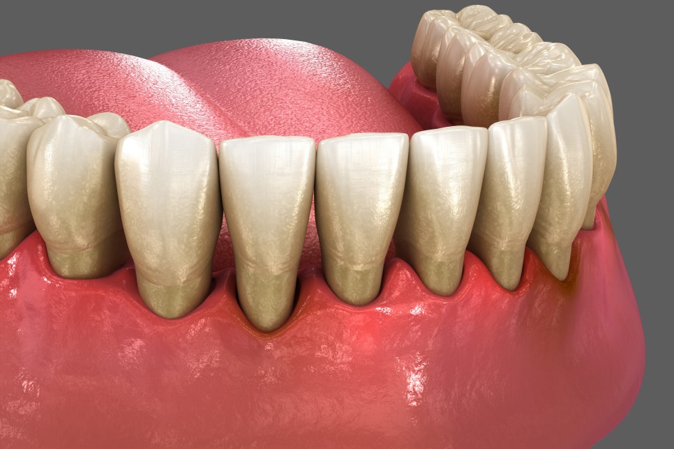 잇몸 부음, 치료 시기를 놓치지 않으려면 관련 이미지 3