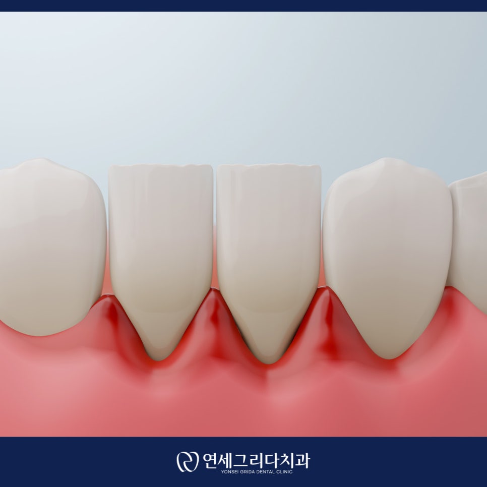 치간칫솔 사이즈 어떻게 골라야 할까요? 관련 이미지 2
