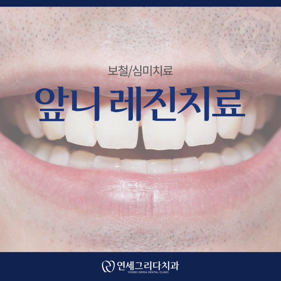 앞니 레진치료, 웃을 때 보이는 틈이 고민이라면 관련 이미지 1