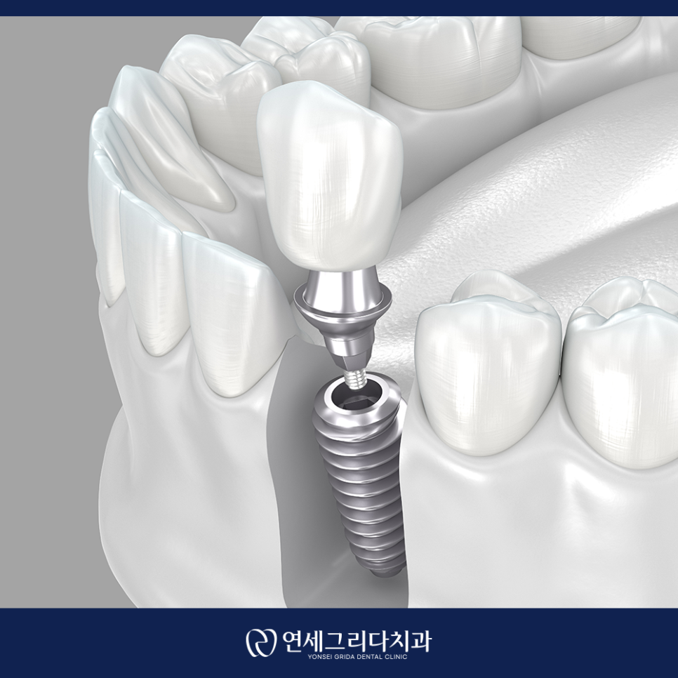 염창역치과, 임플란트 고민이라면 꼭 확인하세요! 관련 이미지 3