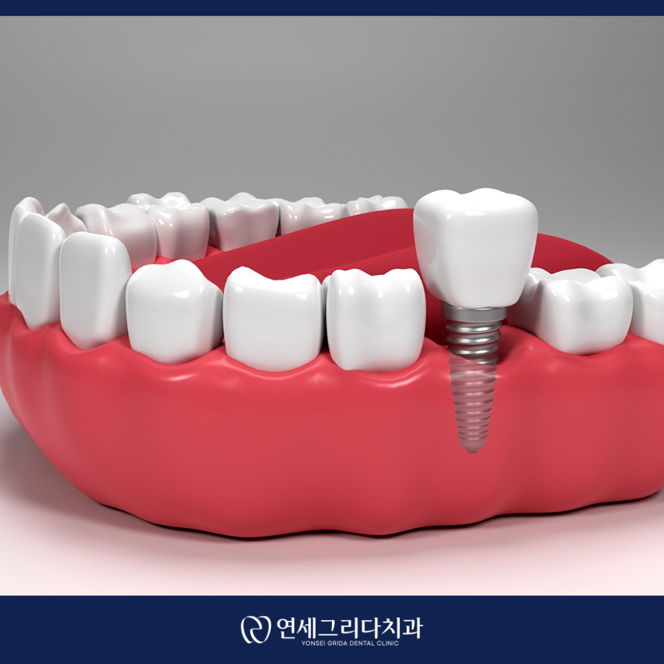 임플란트 후 식사 언제부터 가능할까? 관련 이미지 3