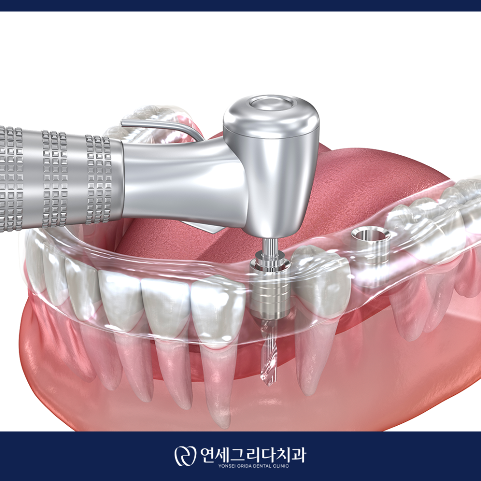 염창역치과, 임플란트 고민이라면 꼭 확인하세요! 관련 이미지 2