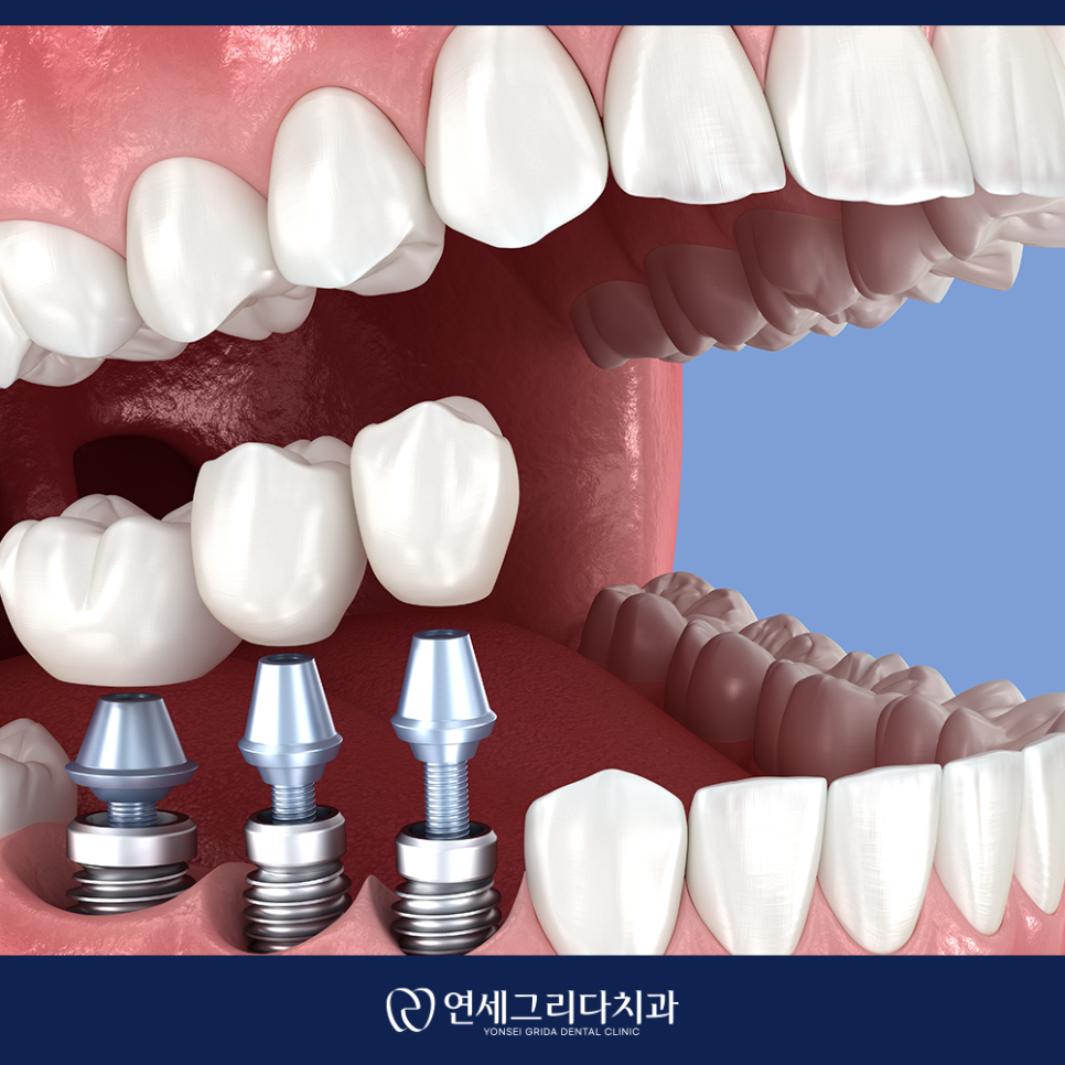 Yeomchang Station Implant, Treatment for Comfortable Eating and Recovery image 2