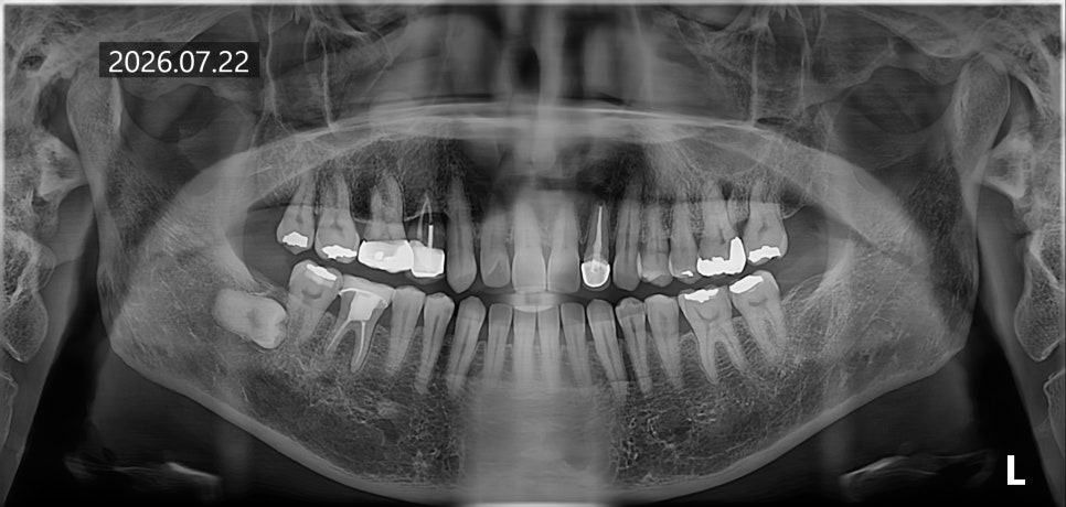 What Happens If You Leave Untreated Cavities Without Symptoms image 1