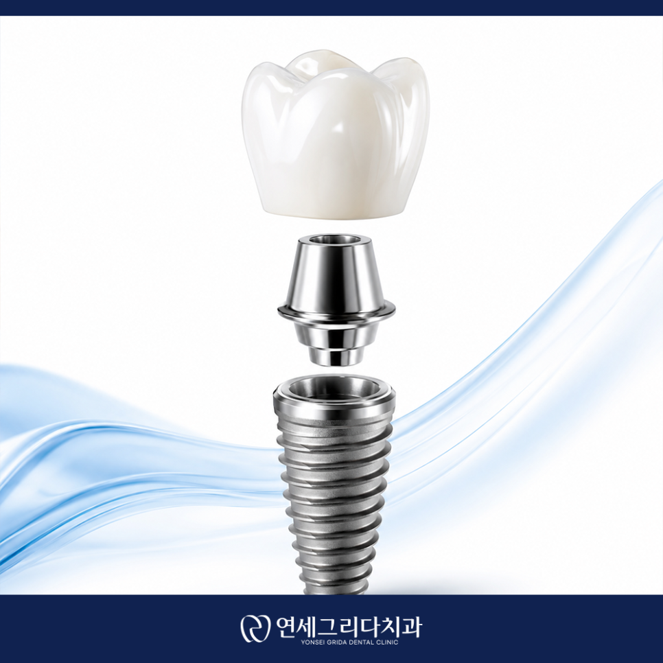 Deungchon Station Dental Implants: How to Use Them for as Long as Natural Teeth image 6