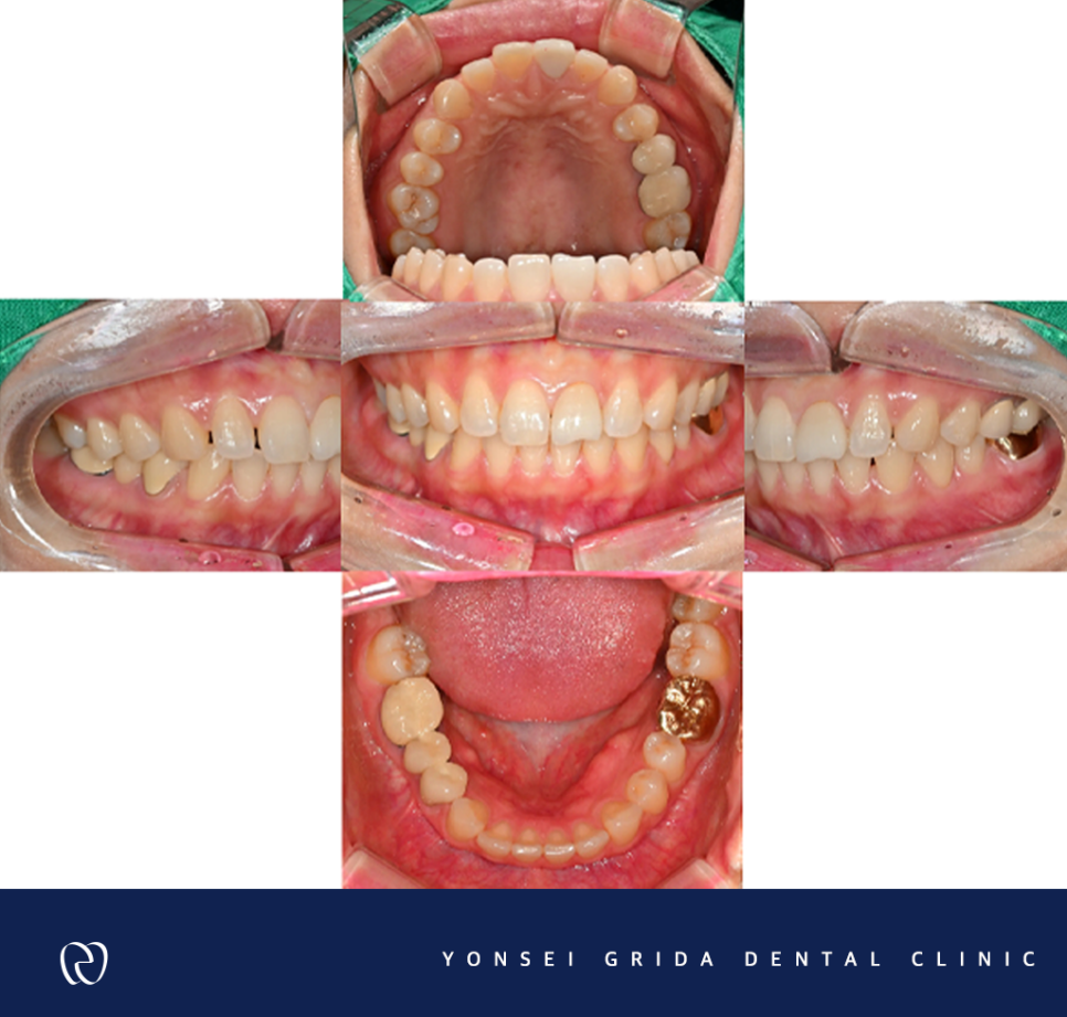 Yeomchang-dong Dental Clinic: The Crown I Had Treated Before Has Broken image 3