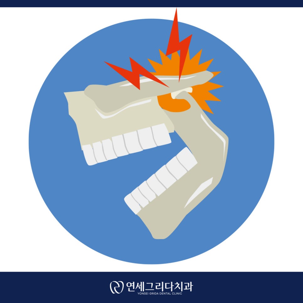 턱관절 통증 입을 벌릴 때 아픈 이유는? 관련 이미지 5