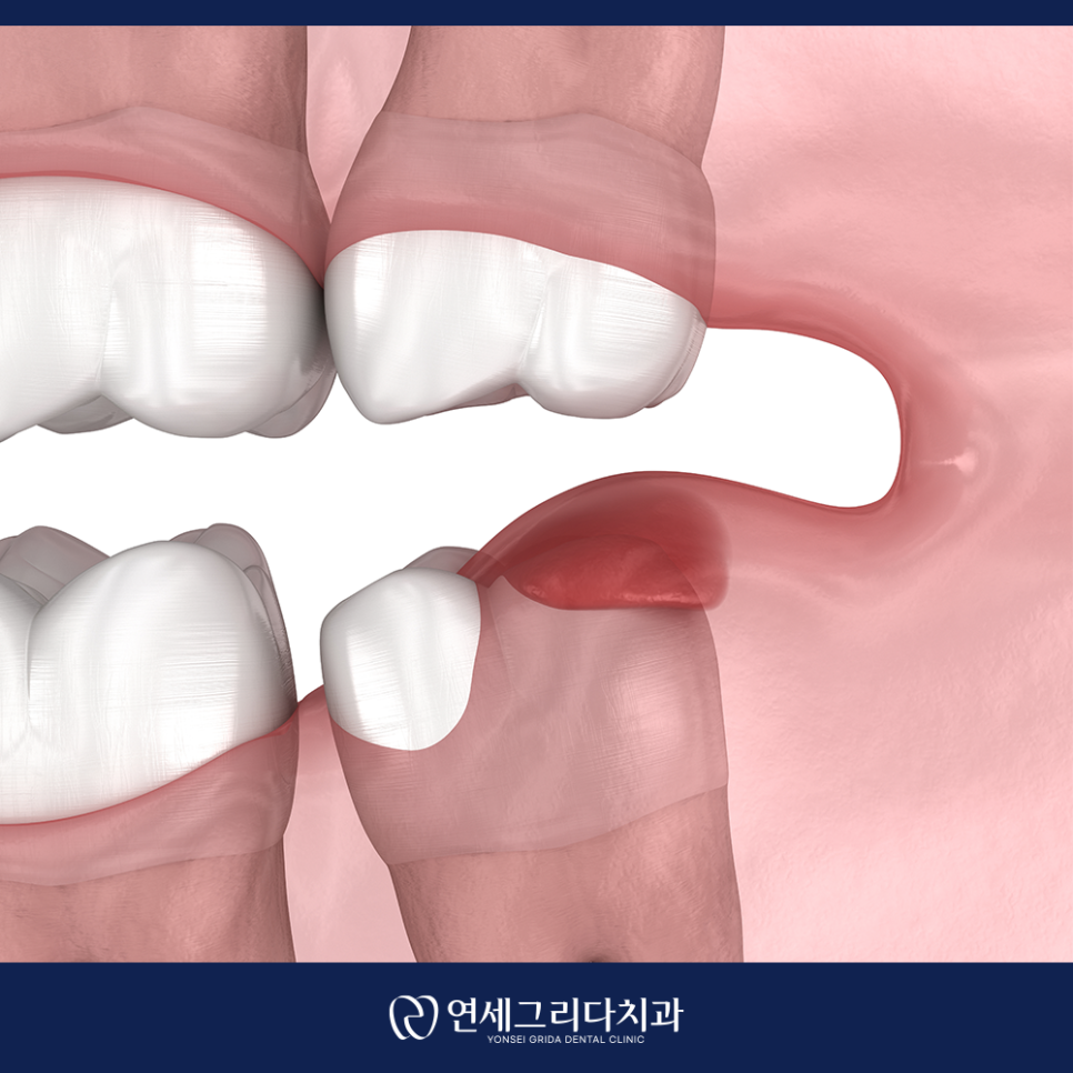 Do You Really Need to Have a Wisdom Tooth Removed at Yeomchang Station? image 3