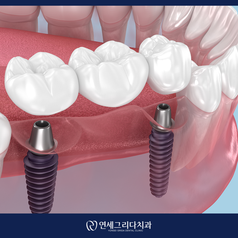 염창역치과, 임플란트 고민이라면 꼭 확인하세요! 관련 이미지 6