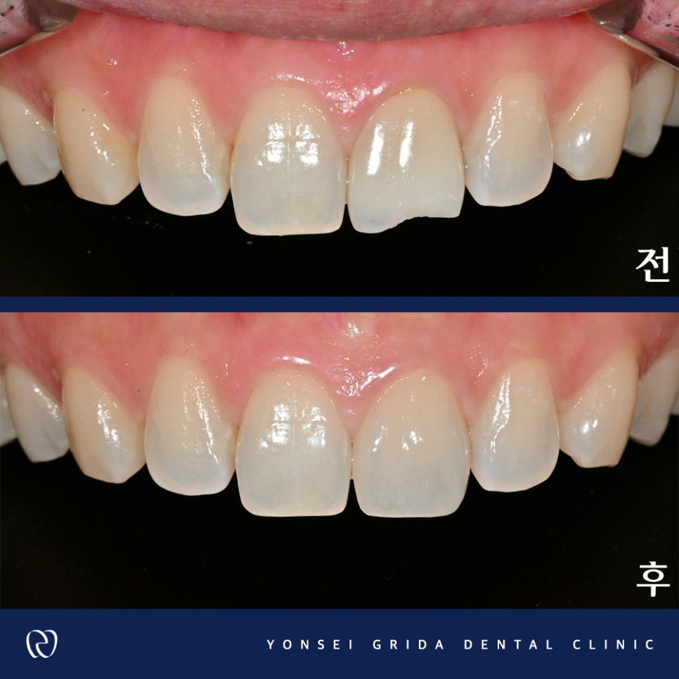Yeomchang-dong Dental Clinic: The Crown I Had Treated Before Has Broken image 8