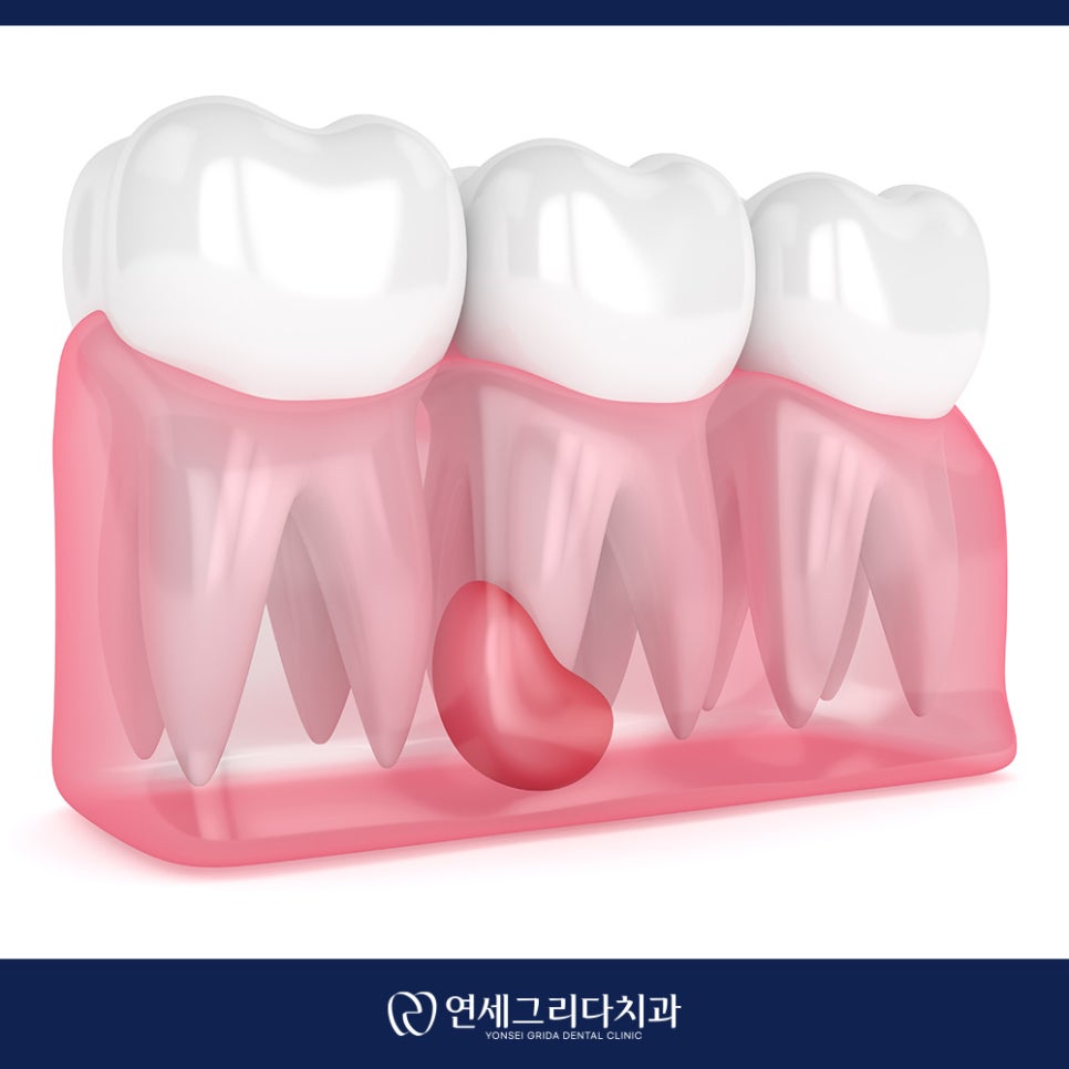 치근단 염증 잇몸에 고름이 생겼다면? 관련 이미지 3