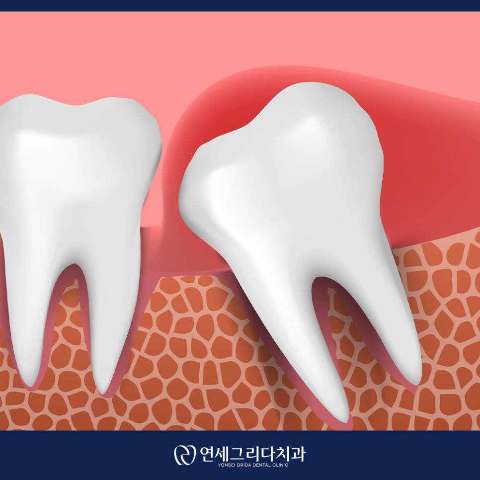 Do You Really Need to Have a Wisdom Tooth Removed at Yeomchang Station? image 4