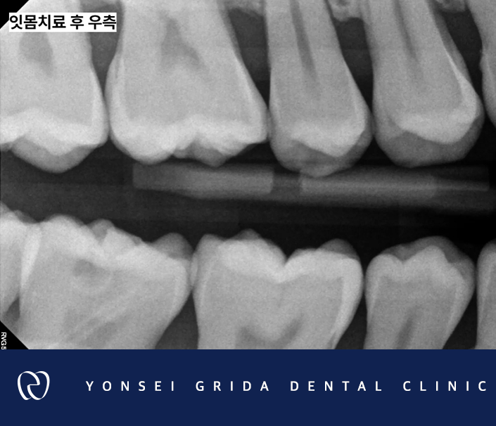 Deungchon Station Dental Clinic: My Front Tooth Broke and My Gums Hurt image 9