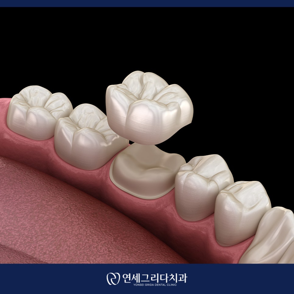 크라운 후 시림 계속 지속된다면? 관련 이미지 6