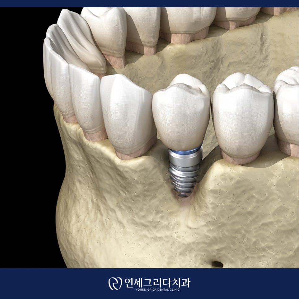 임플란트 흔들림 방치하면 생길 수 있는 문제는? 관련 이미지 3