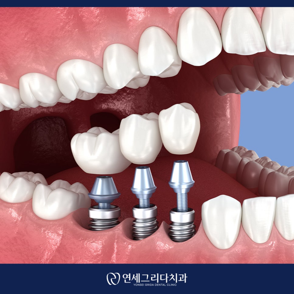 임플란트 흔들림 방치하면 생길 수 있는 문제는? 관련 이미지 6