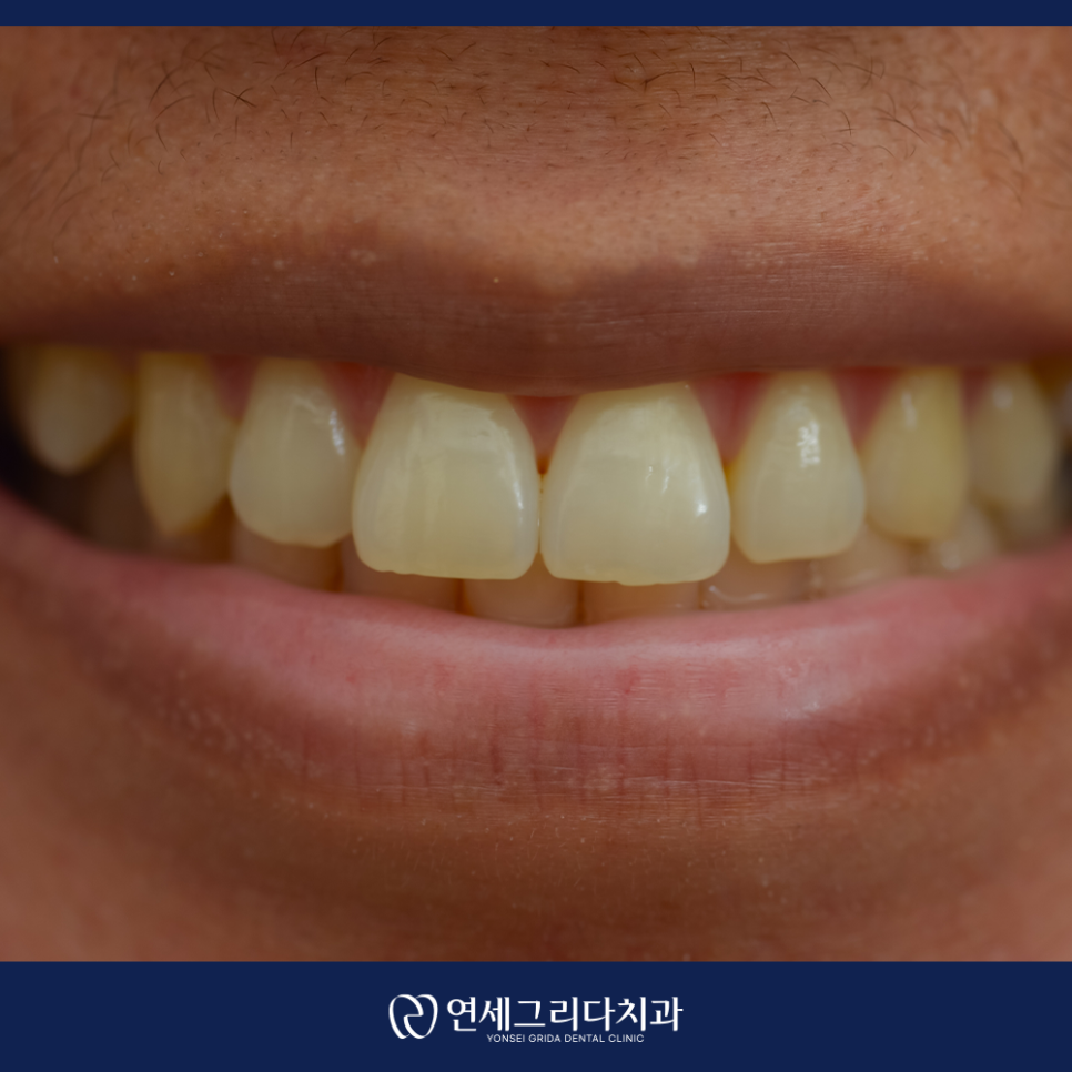 앞니 레진치료, 웃을 때 보이는 틈이 고민이라면 관련 이미지 5