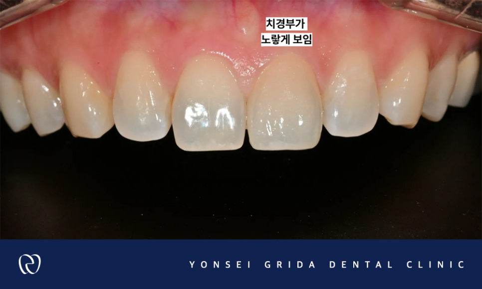 Yeomchang-dong Dental Clinic: The Crown I Had Treated Before Has Broken image 5