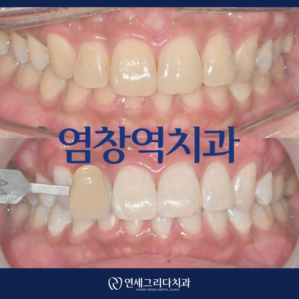 Yeomchang Station Dental Clinic: If You Want to Brighten Your Tooth Color in a Short Time with One-Day Whitening image 1