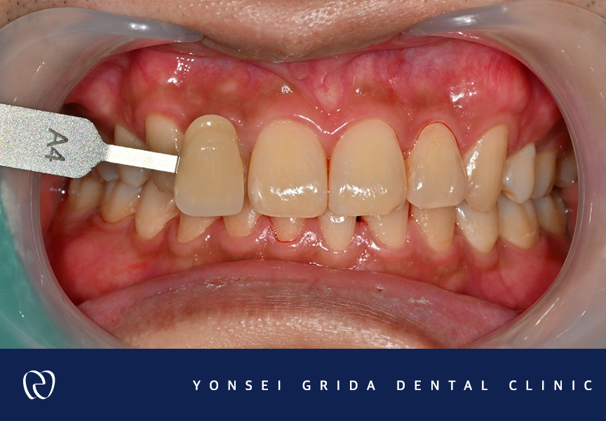 Yeomchang Station Dental Clinic: If You Want to Brighten Your Tooth Color in a Short Time with One-Day Whitening image 2