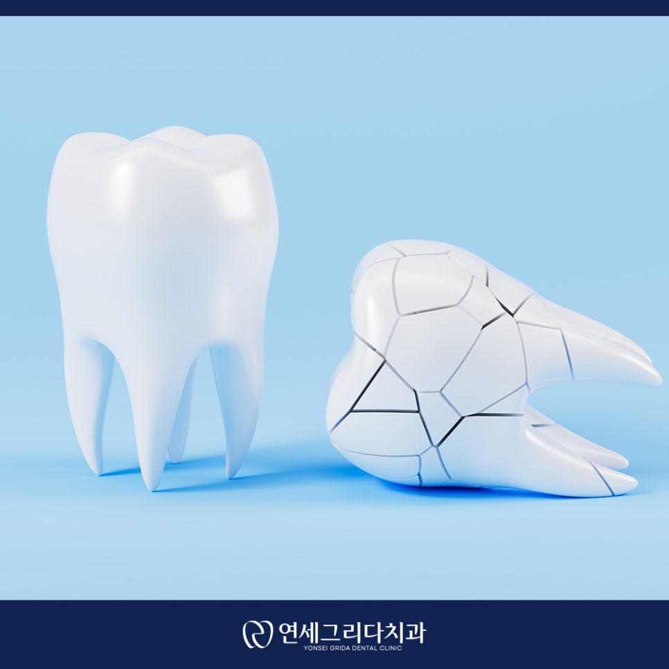 치아 크랙 씹을 때마다 통증이 생긴다면 관련 이미지 7