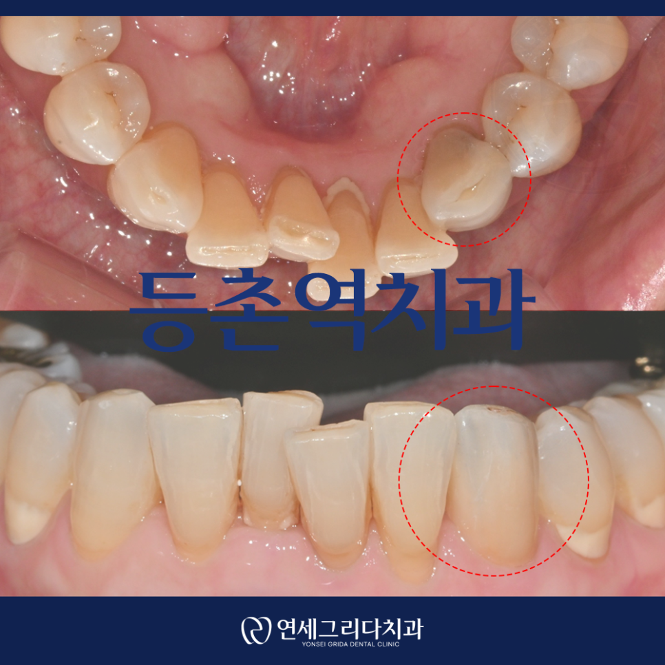 등촌역치과, 신경치료 후 치아가 약해졌다면 관련 이미지 1