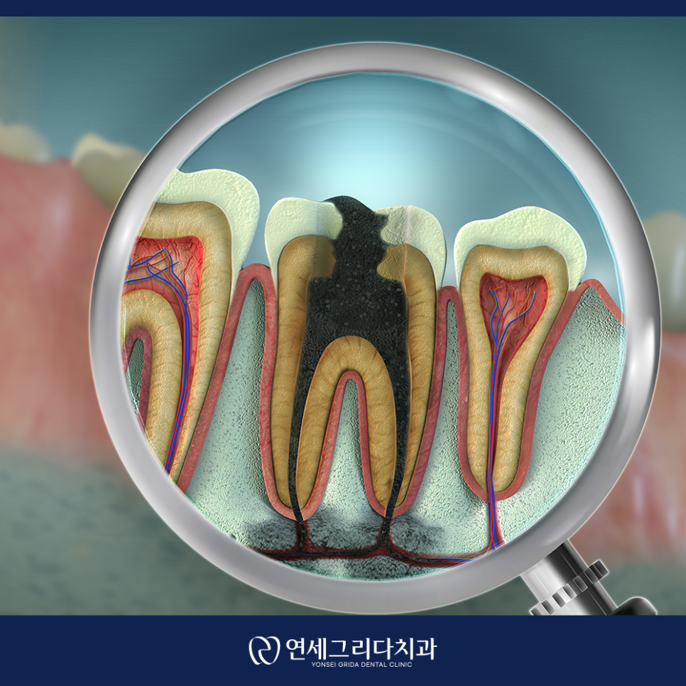 충치치료 통증, 무서워서 미루고 계셨나요? 관련 이미지 4