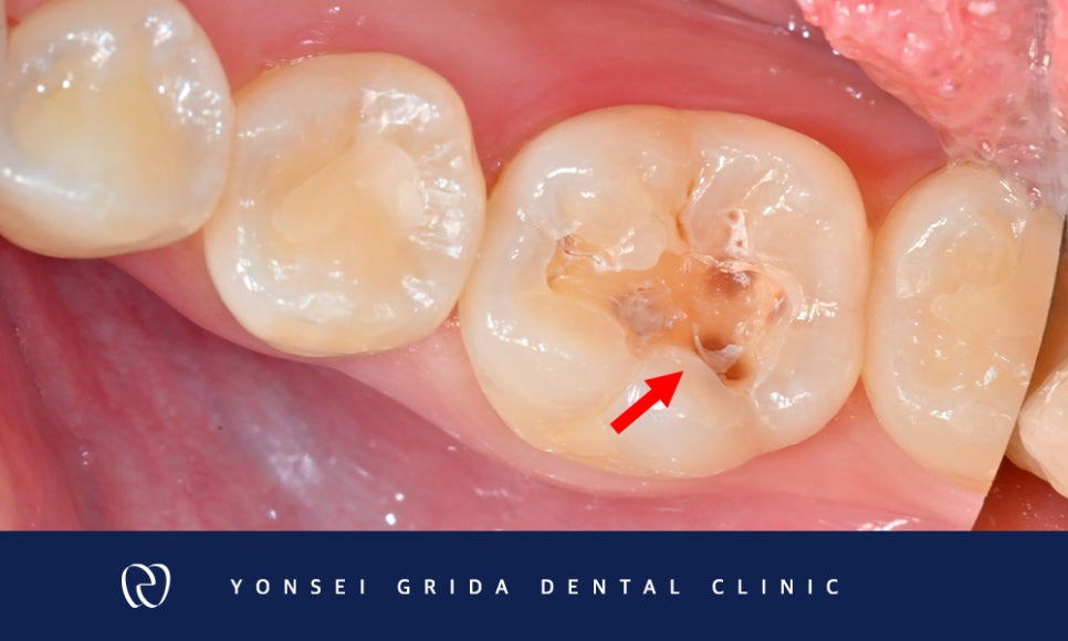 Yeomchang Station Cavity Treatment: I Visited for an Overall Checkup image 4