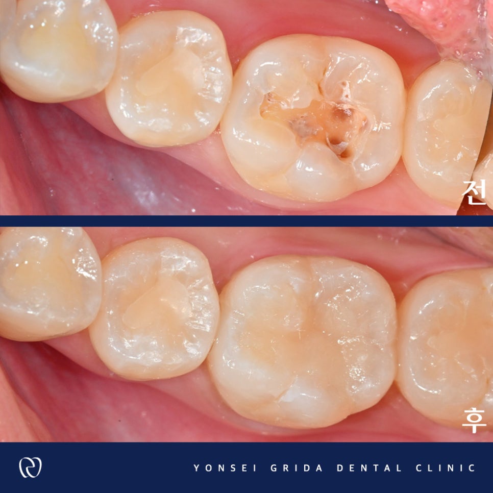 Yeomchang Station Cavity Treatment: I Visited for an Overall Checkup image 6