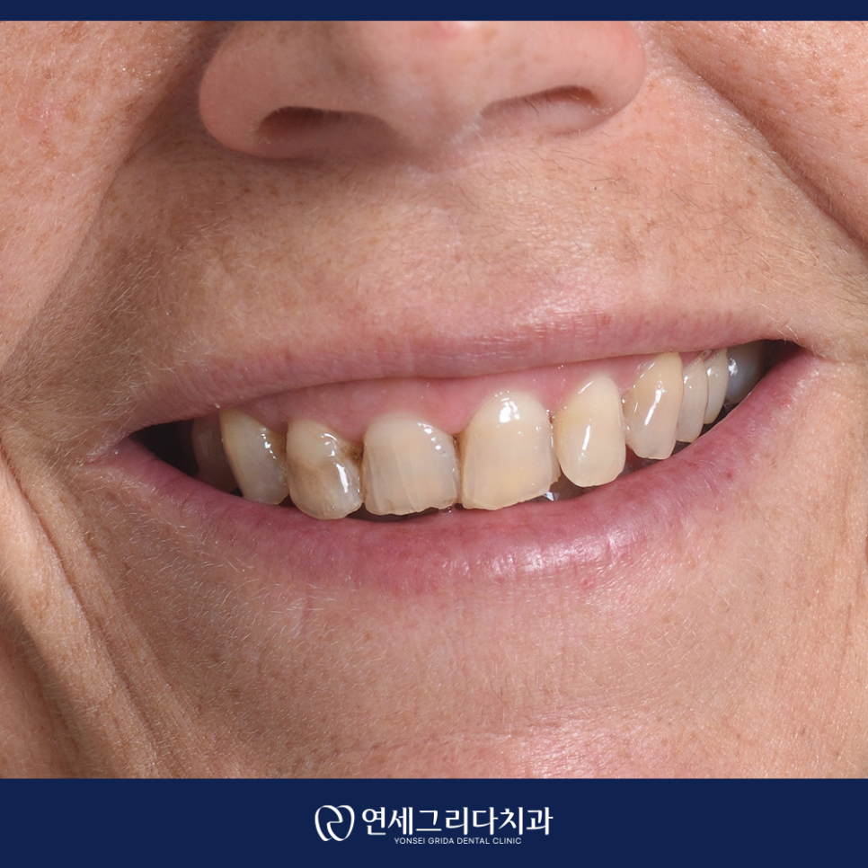What Is That Black Spot on Your Tooth? Distinguishing Staining from Cavities image 3