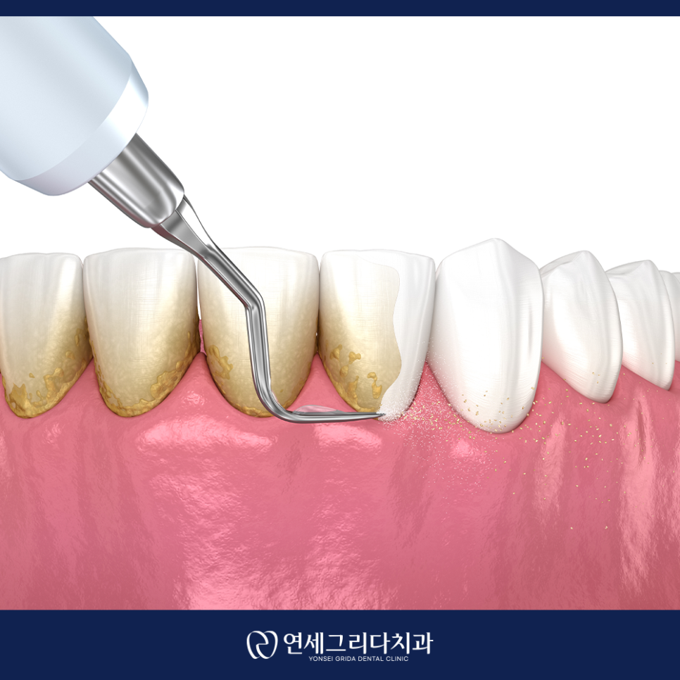 염창역잇몸치료, 양치할 때 자꾸 피가 난다면? 관련 이미지 5