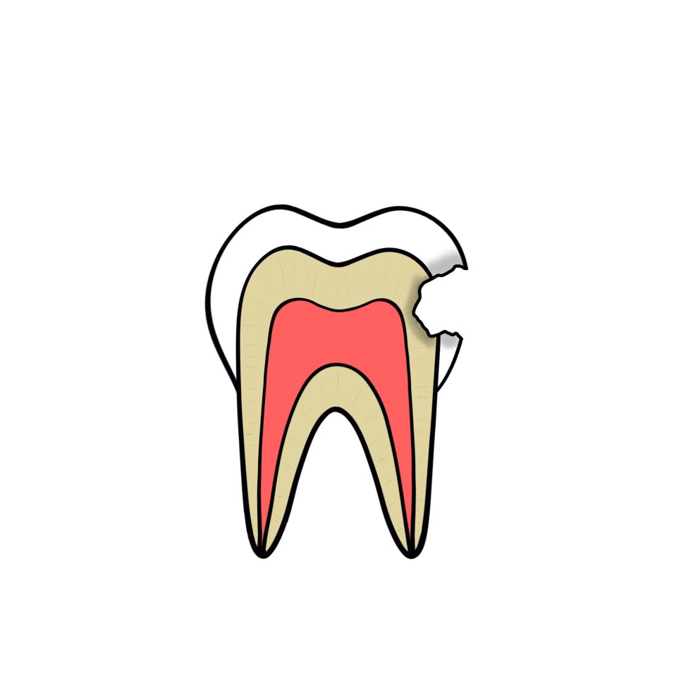 인접면 충치 조기 발견이 중요한 이유는? 관련 이미지 6