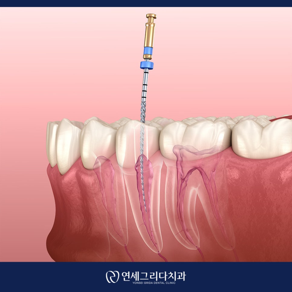 치아 크랙 씹을 때마다 통증이 생긴다면 관련 이미지 5