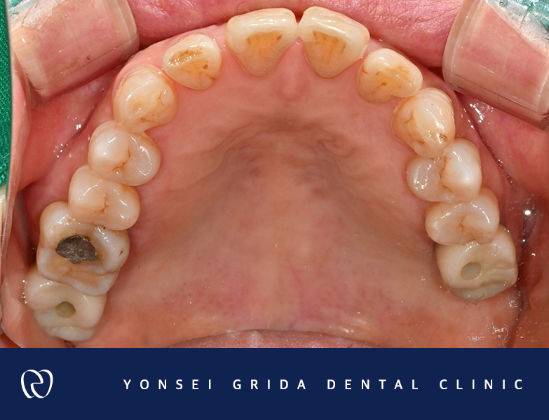 Recommended Dentist in Yeomchang-dong: My Front Teeth Are Chipped and Gapped image 5